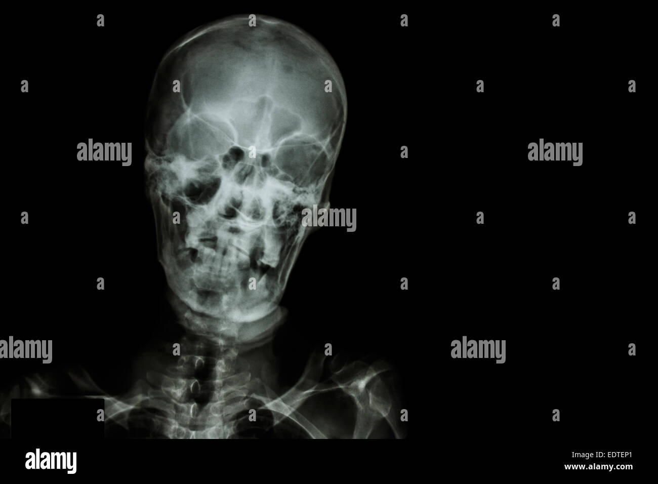 Film X-ray cranio e la zona vuota a destra Foto Stock