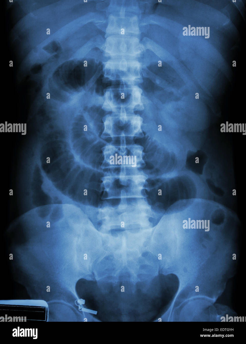 'Small ostruzione intestinale' film X-ray addome supino : visualizza il piccolo intestino dilatare Foto Stock