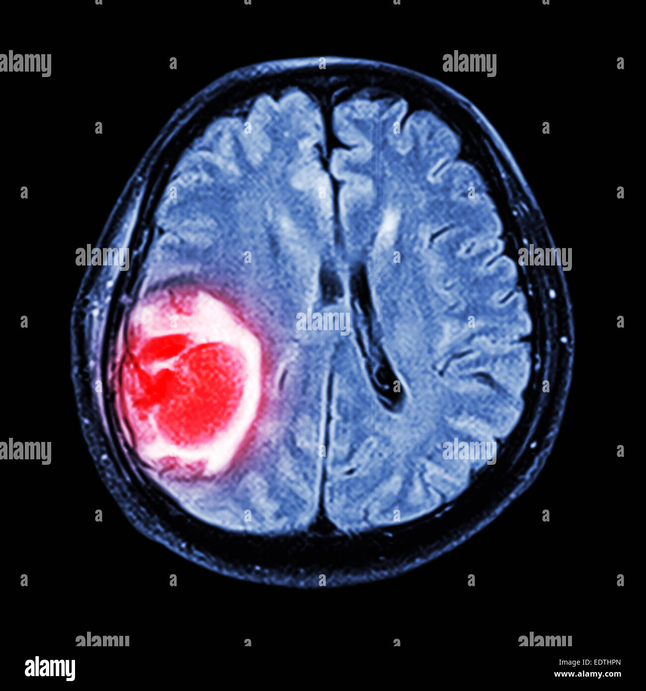 MRI brain : mostra tumore al cervello a destra del lobo parietale del cervello Foto Stock