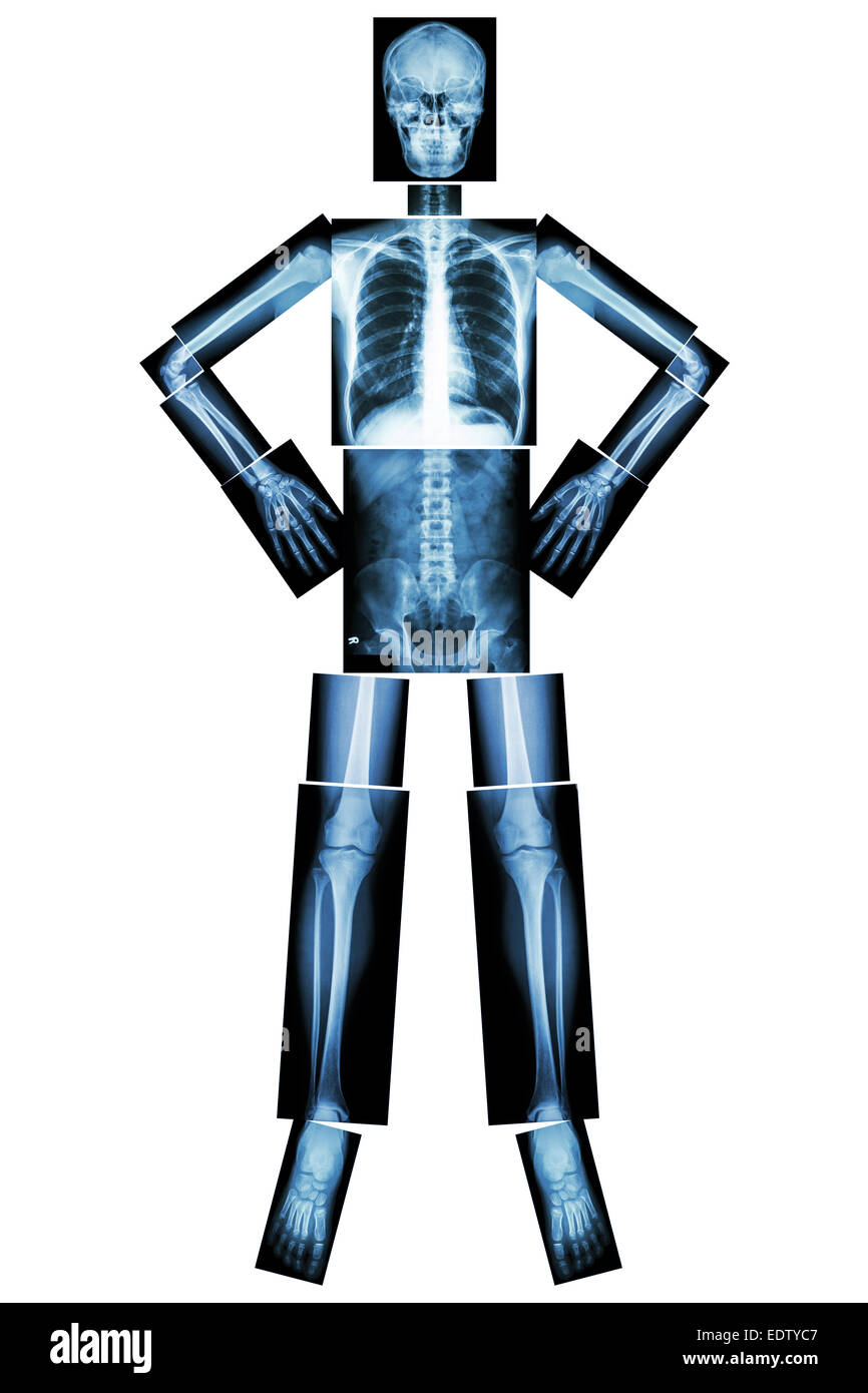 Un osso umano di stand e akimbo (X-ray tutto il corpo : testa collo cranio colonna vertebrale spalla gomito del braccio avambraccio polso mano dito torace torace Foto Stock