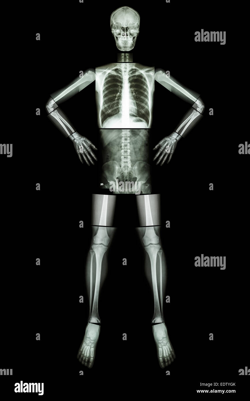 Un osso umano di stand e akimbo (X-ray tutto il corpo : testa collo cranio colonna vertebrale spalla gomito del braccio avambraccio polso mano dito torace torace Foto Stock