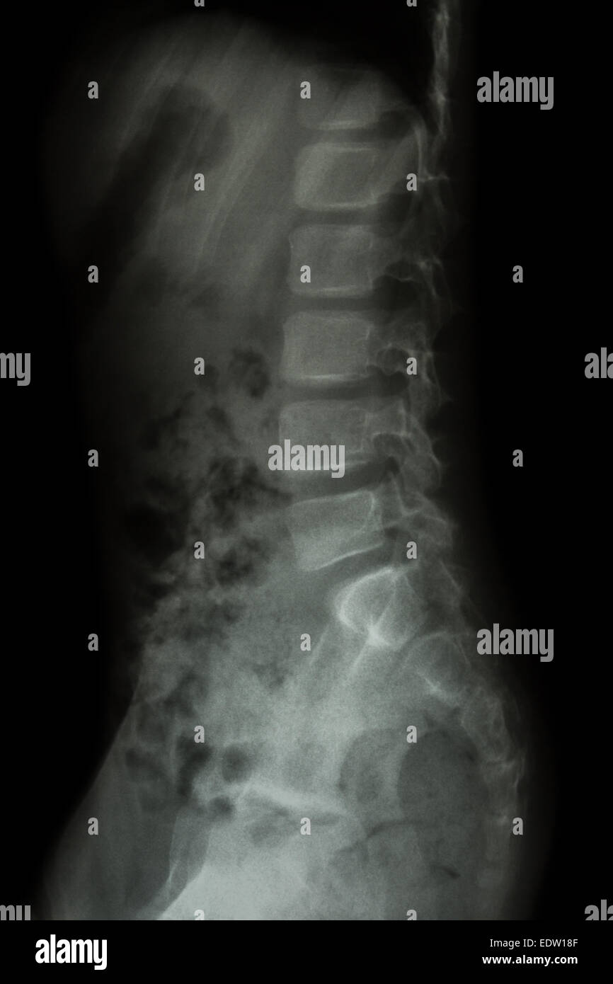 Lombare della colonna vertebrale del bambino ( X-ray - toracica della colonna vertebrale lombare ) ( vista laterale ) Foto Stock