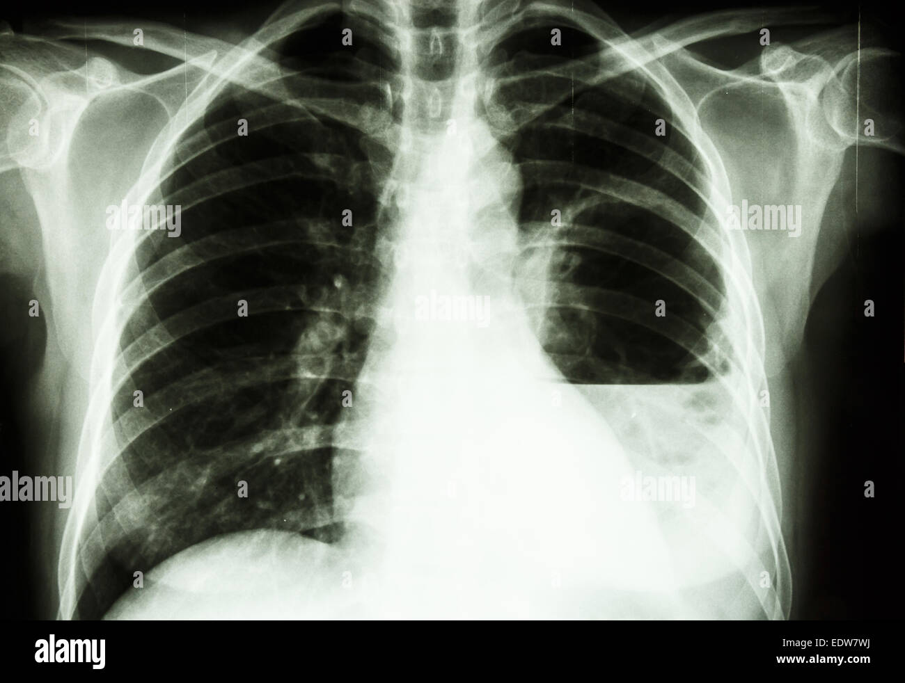 Film X-ray show polmone sinistro ascesso da Burkholderia pseudomallei infezione (Mellioidosis) Foto Stock