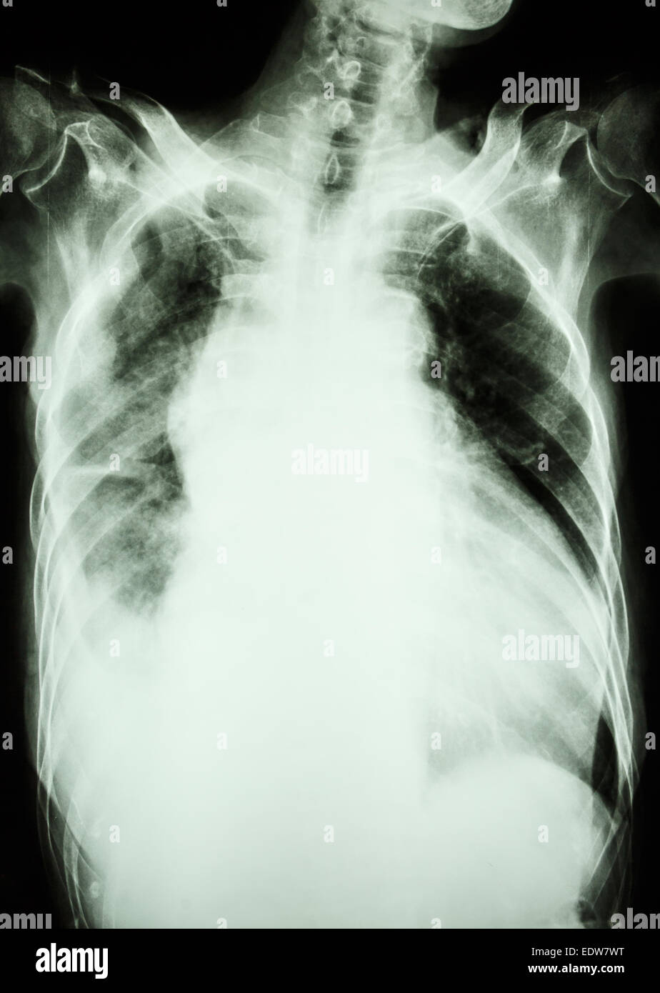 Film X-ray show infiltrarsi e effusione al polmone destro da infezione da Mycobacterium tuberculosis (tubercolosi polmonare) Foto Stock