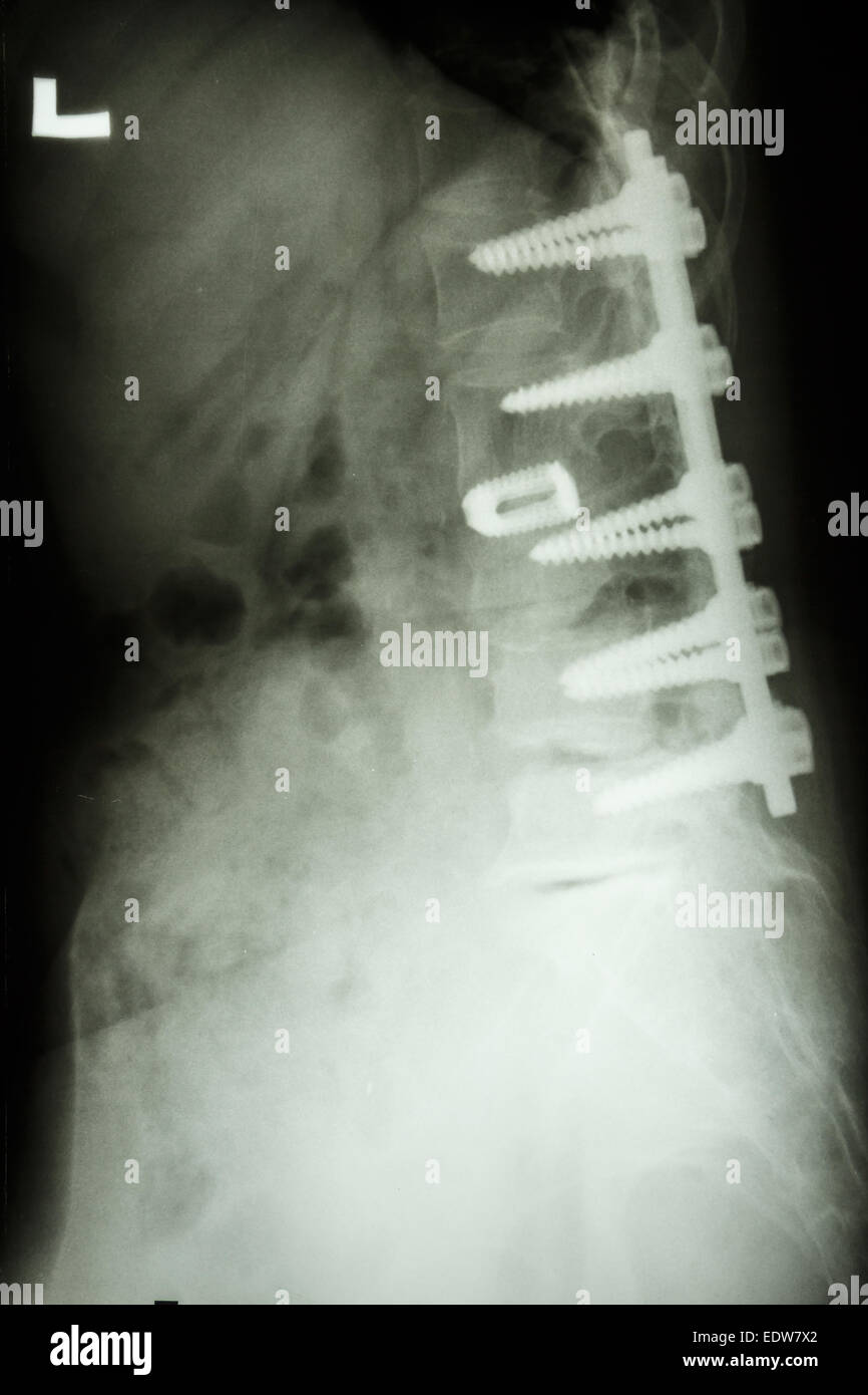 Film X-ray show della colonna vertebrale lombare con vite peduncolare fissaggio nel paziente spondylolithesis Foto Stock