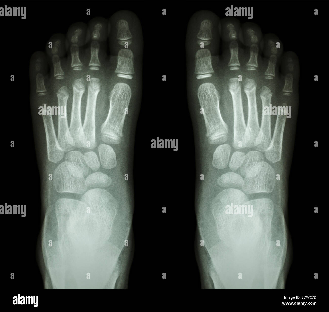 X-ray normale del bambino morchie Foto Stock