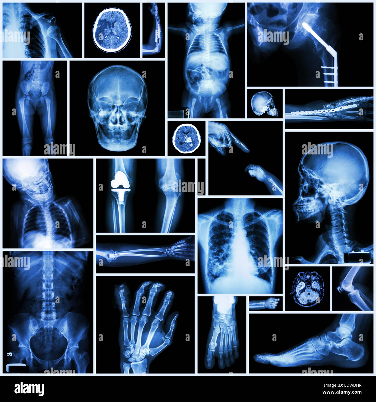 Collezione X-ray 'Multiple parte dell' umano ,"di chirurgia ortopedica' e 'Multiple malattia" (frattura,lussazione di spalla,Osteoarthr Foto Stock