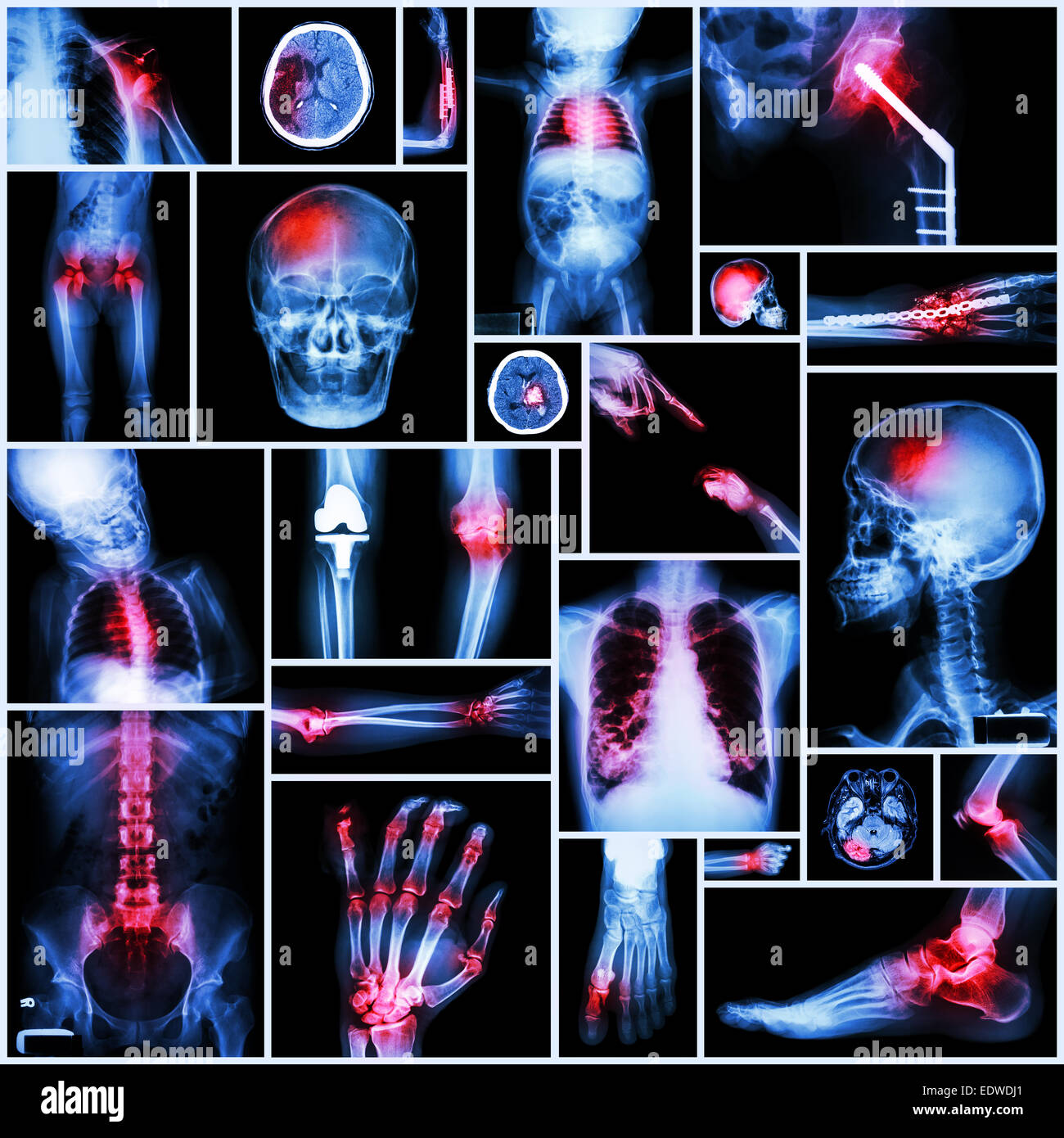 Raccolta di raggi X più parte dell'umana,operazione ortopedica e malattia multipli (spalla lussazione,CP,frattura,Gotta, Foto Stock