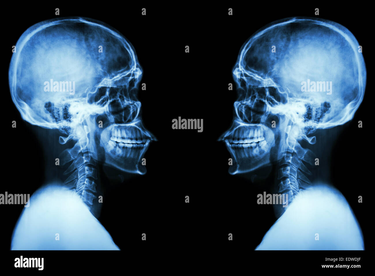 Raggi X del cranio e della colonna vertebrale cervicale Foto Stock