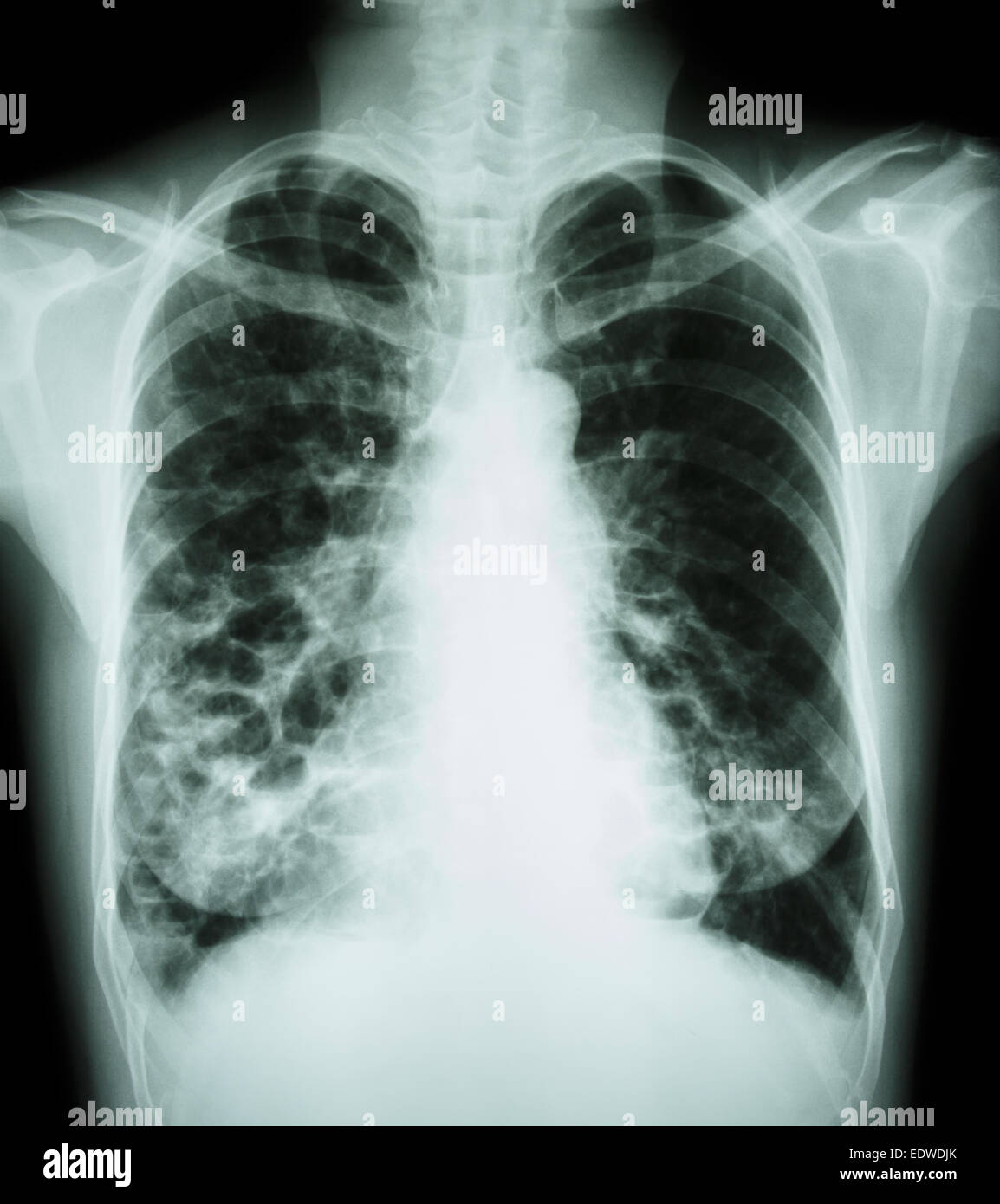 "Broncoectasia' X-ray petto show : polmonari multiple bolla e cisti a causa di infezione cronica Foto Stock