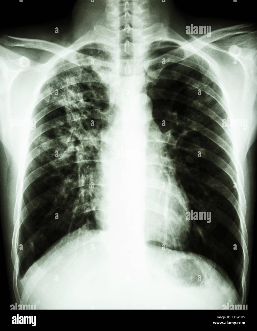 Film i raggi x al torace PA montante : mostra infiltrazione interstiziale al polmone destro a causa di infezione da Mycobacterium tuberculosis (polmonare Foto Stock