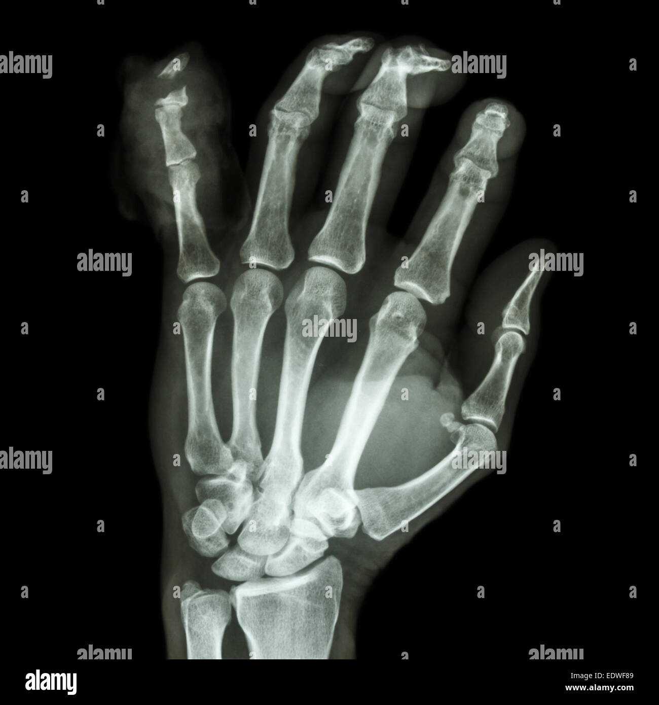 Film x-ray mano AP : mostra frattura pharange distale dito mignolo Foto  stock - Alamy