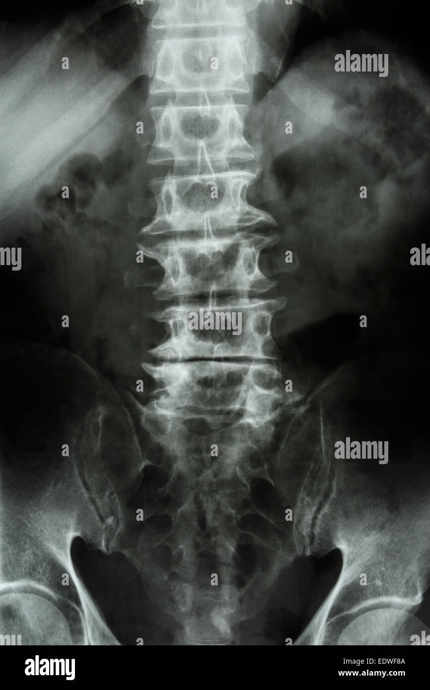 'Spondylosis' film x-ray L-S (dorso-lombare sacrum) di vecchia età paziente Foto Stock