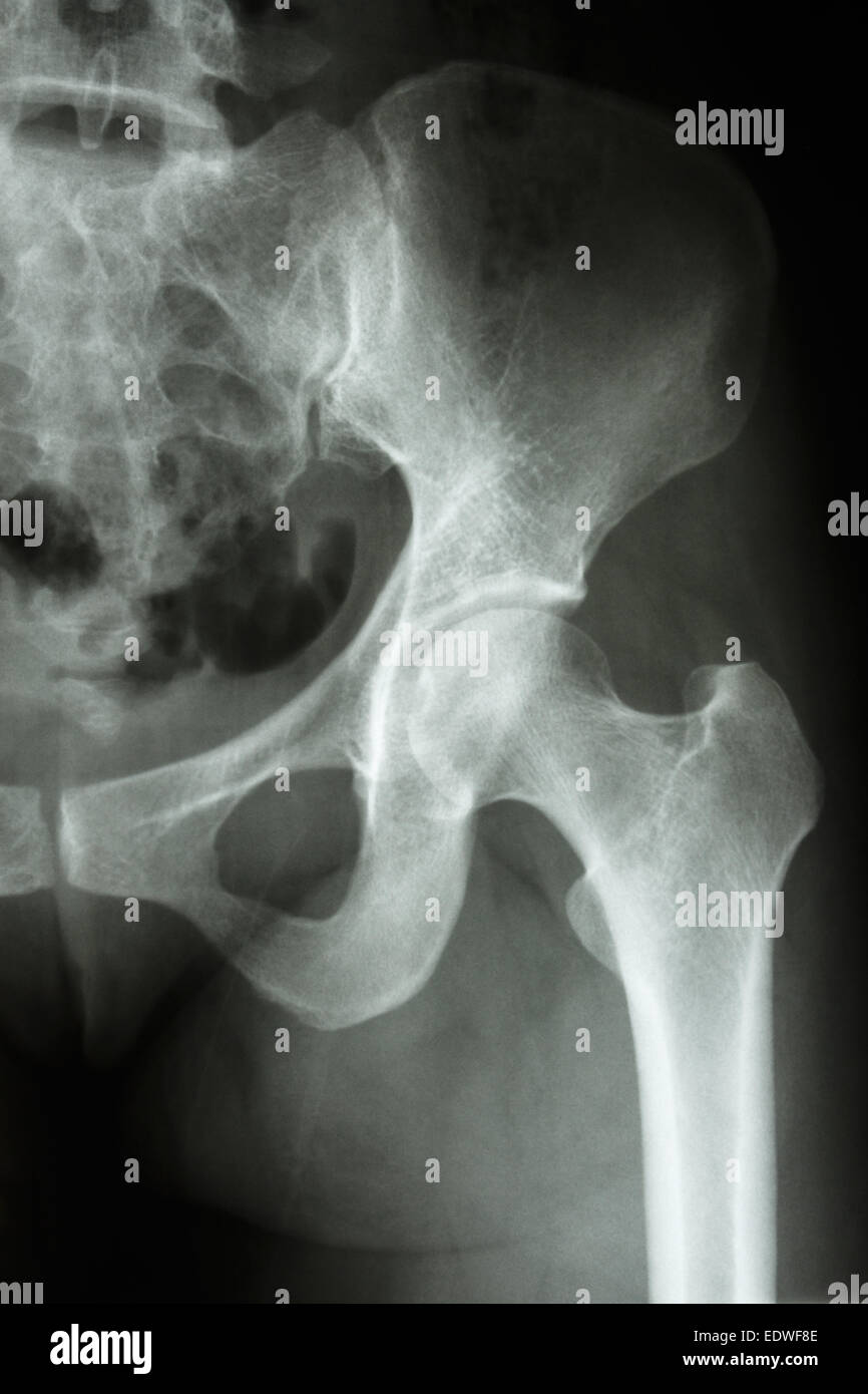 Film x-ray anca sinistra : mostra umano normale l'anca Foto Stock
