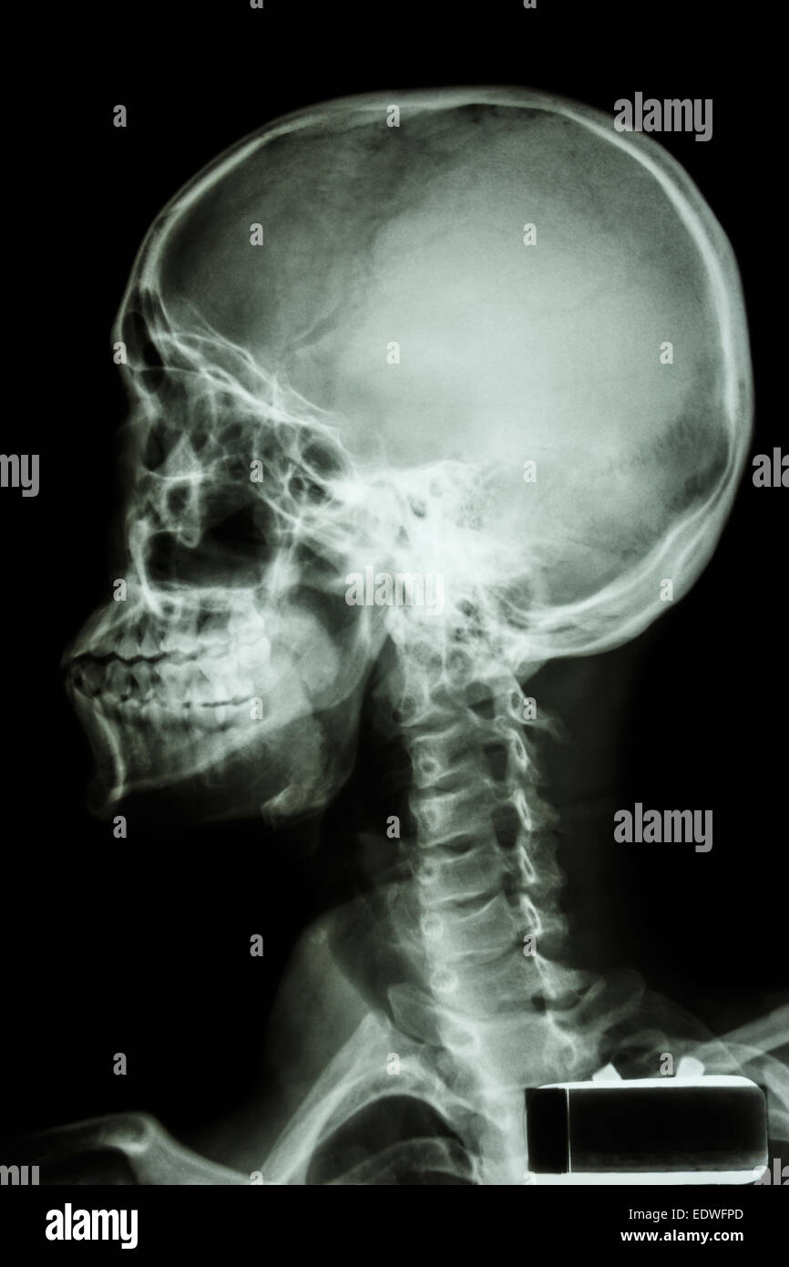 La pellicola a raggi x della umana del cranio e della colonna vertebrale cervicale Foto Stock