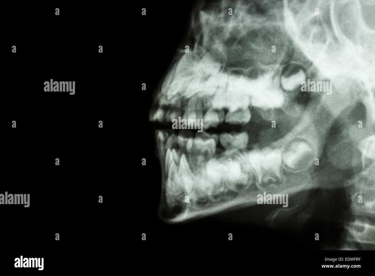 La pellicola a raggi x della umana ganascia e i denti e la zona vuota a sinistra Foto Stock