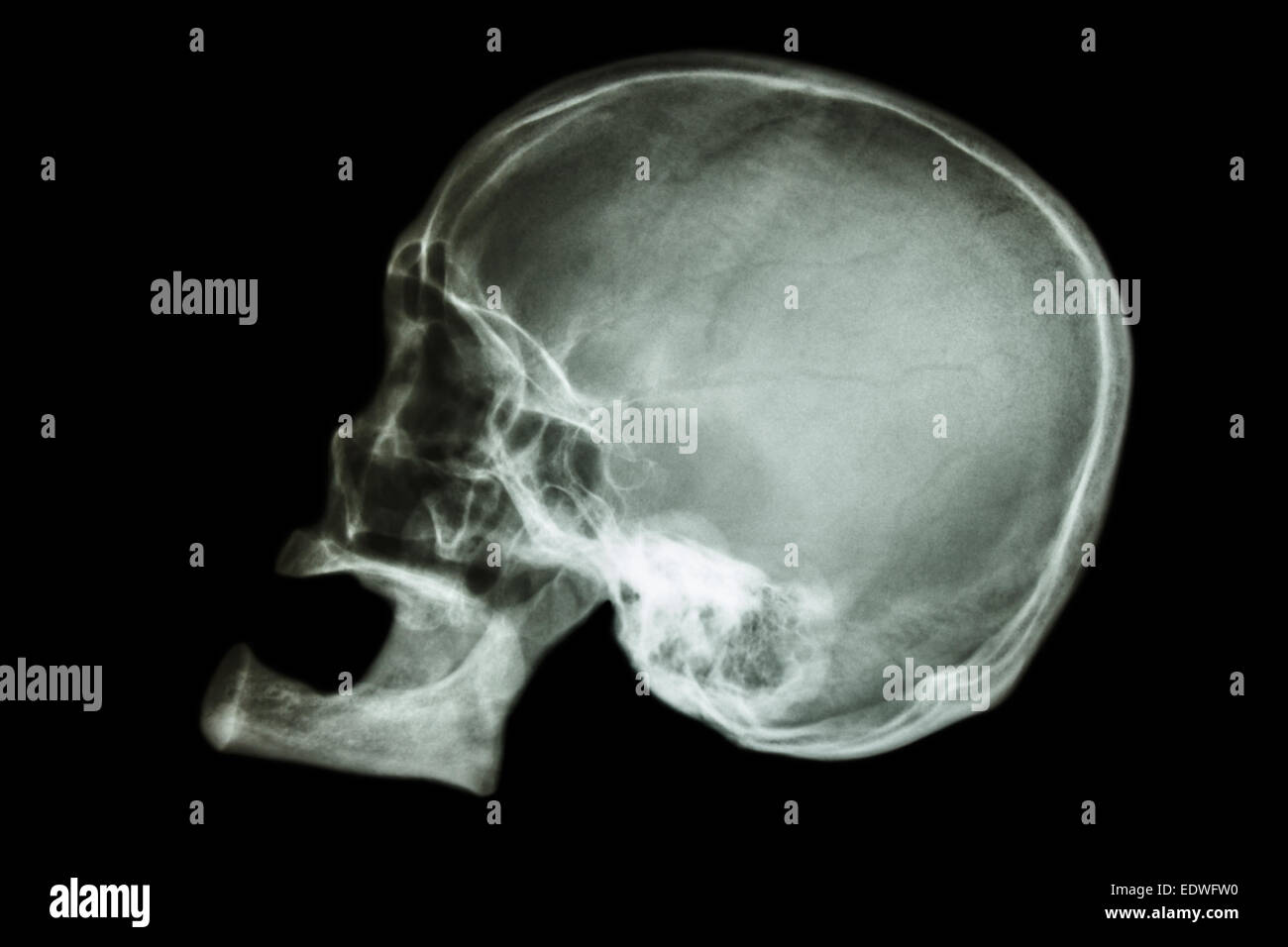 Vecchia età asian del cranio (popolo Thai) , (nessun dente) Foto Stock