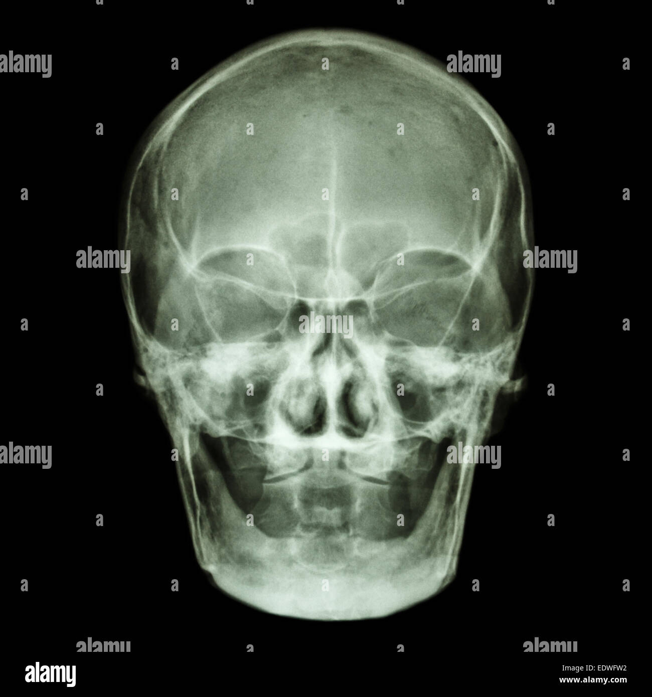 Film x-ray cranio AP : mostra il normale vecchia età asian del cranio (popolo tailandese), (nessun dente) Foto Stock