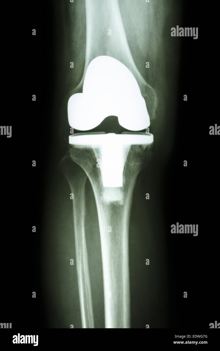 Protesi articolare del ginocchio (articolazione artificiale) di osteoartrite paziente Foto Stock