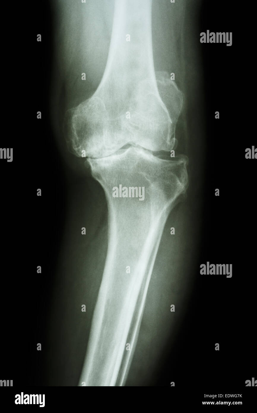 Film x-ray ginocchio AP di osteoartrite del ginocchio del paziente (OA ginocchio) Foto Stock
