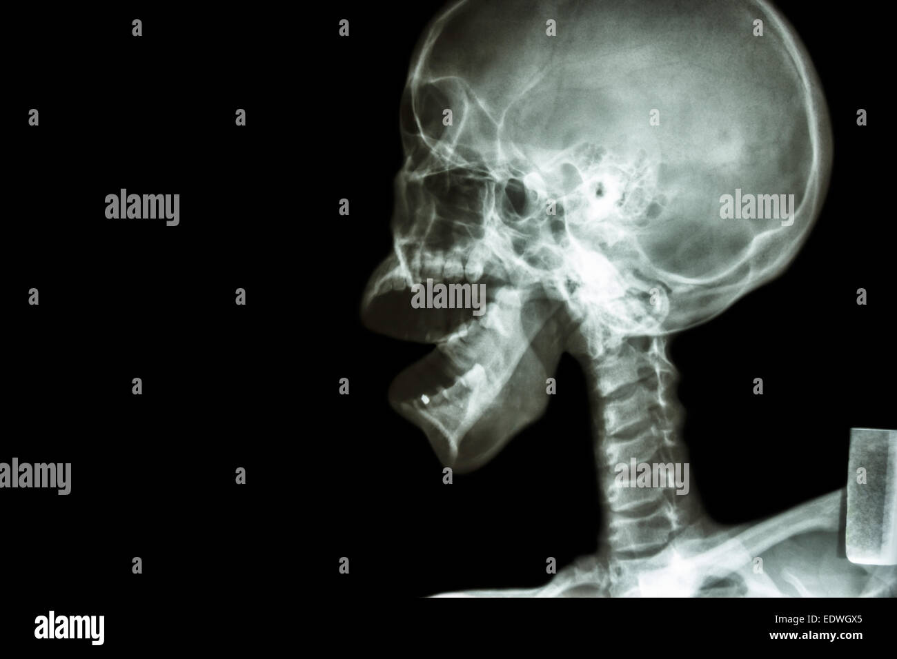 X-ray asian il cranio e la bocca aperta Foto Stock