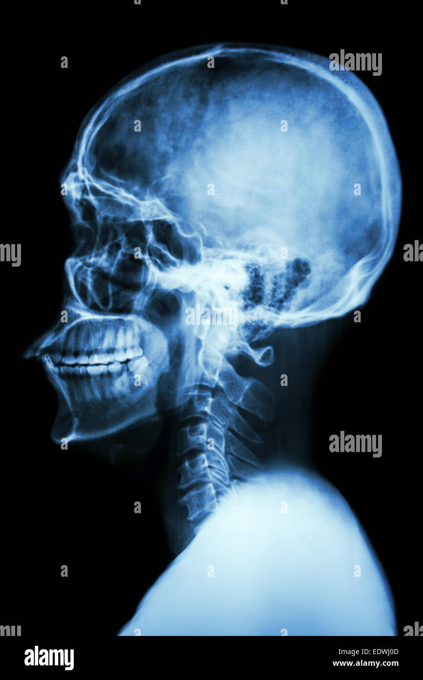 X-ray asian del cranio e della colonna vertebrale cervicale Foto Stock