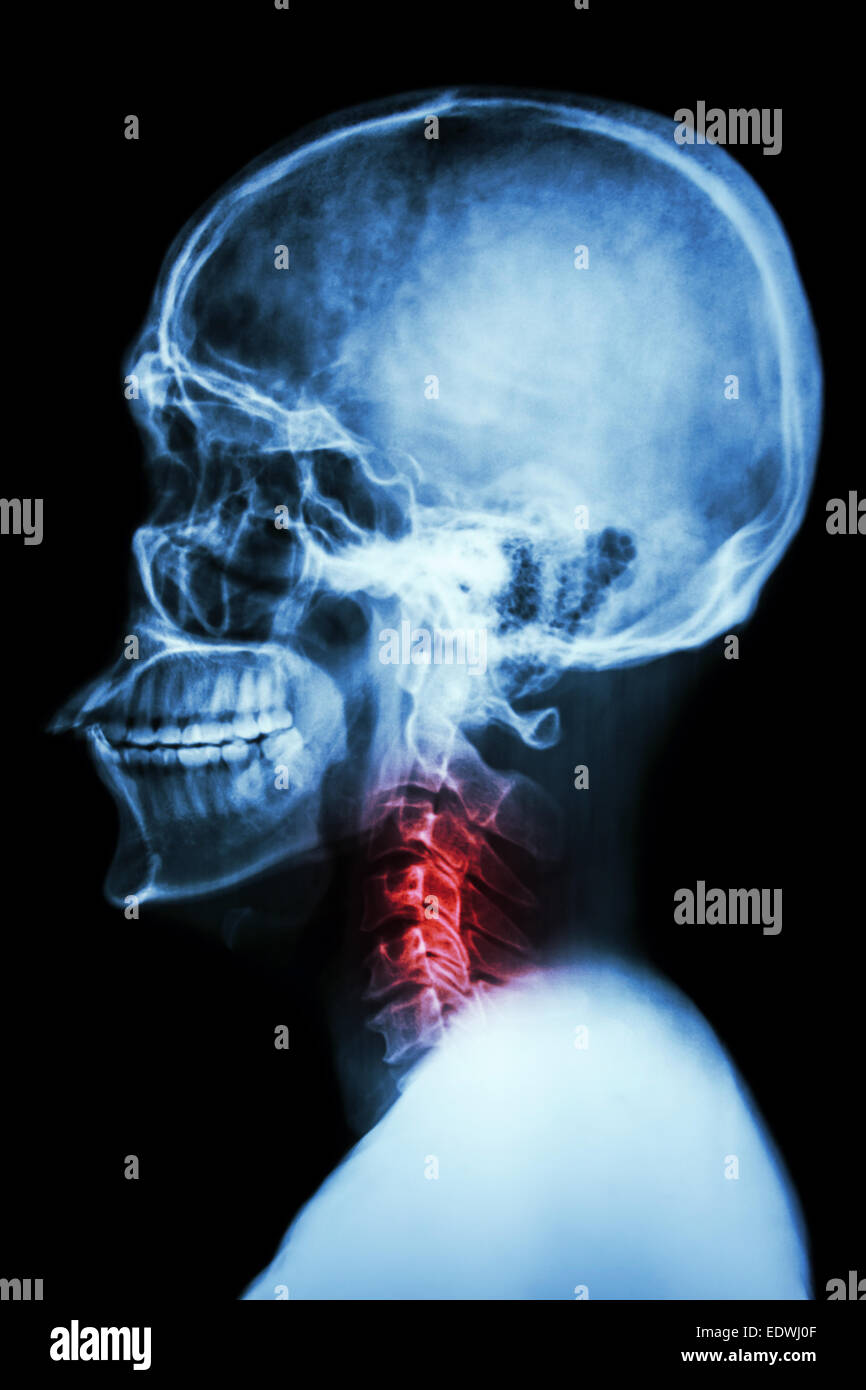 X-ray asian del cranio e della colonna vertebrale cervicale e dolore al collo Foto Stock