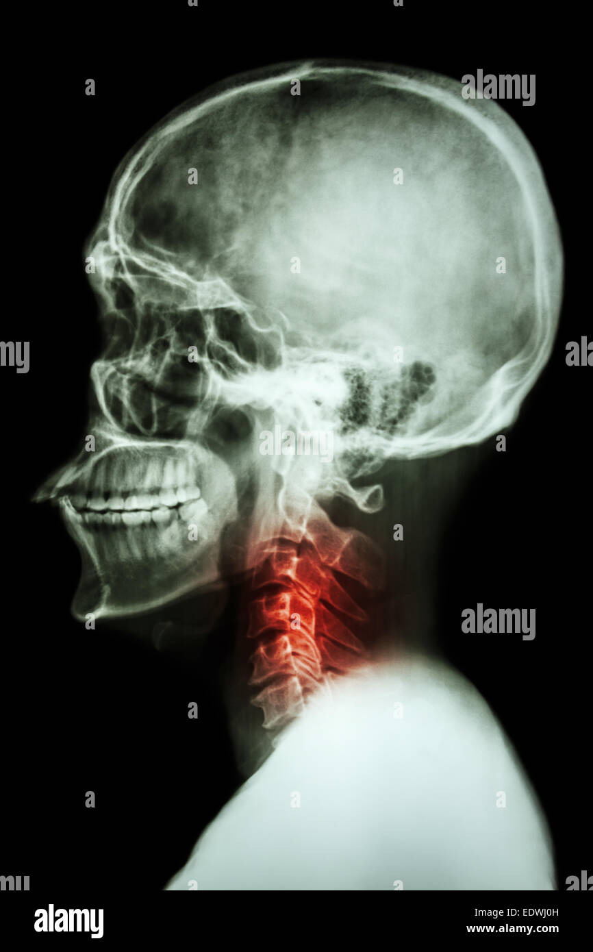 X-ray asian del cranio e della colonna vertebrale cervicale e dolore al collo Foto Stock