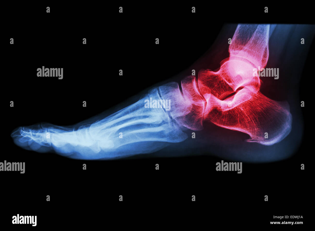 X-ray dell umano alla caviglia con artrite ( Gotta , artrite reumatoide) Foto Stock