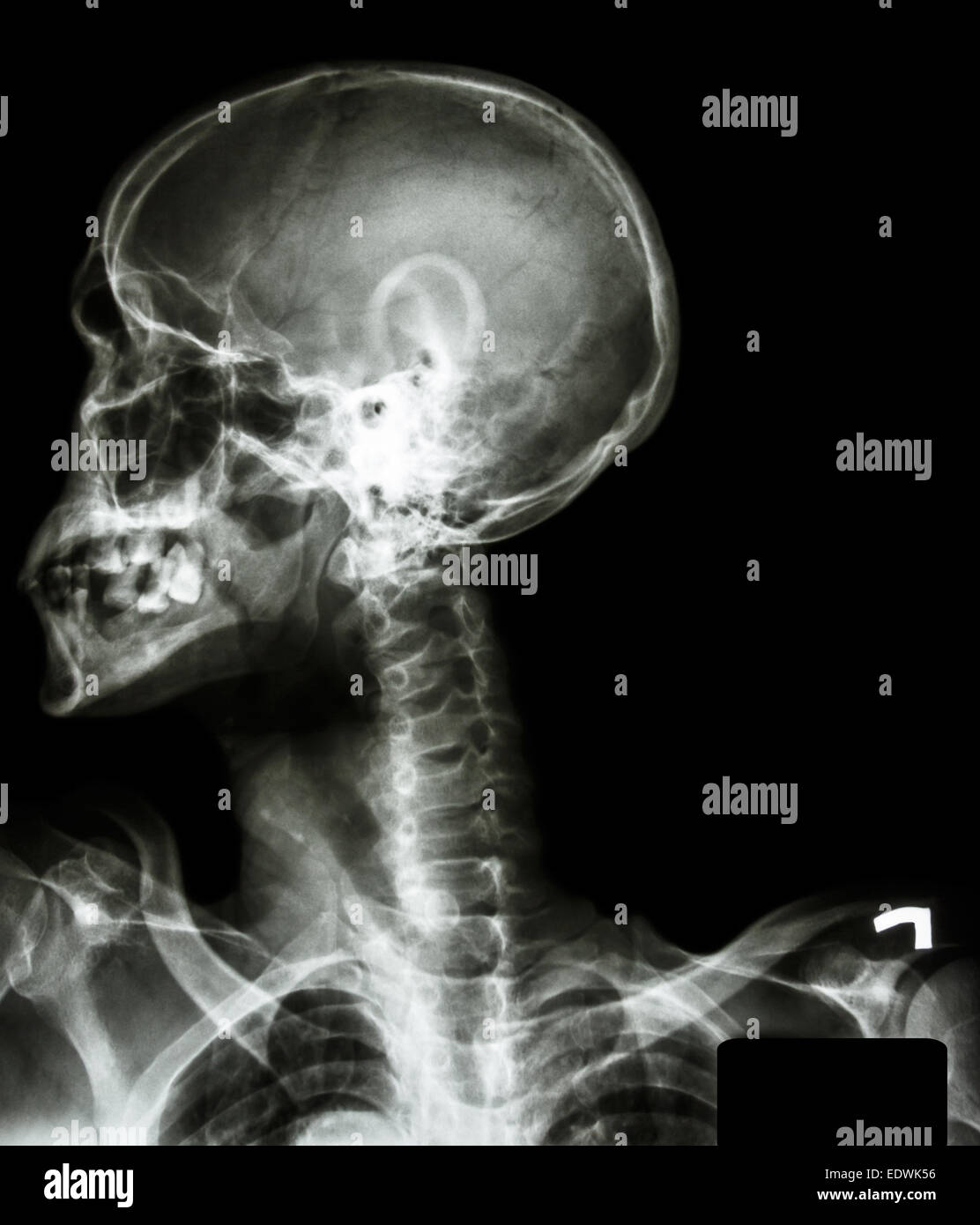 X-ray cranio asiatica(popolo thai),colonna cervicale,sia la spalla e la zona vuota a destra Foto Stock