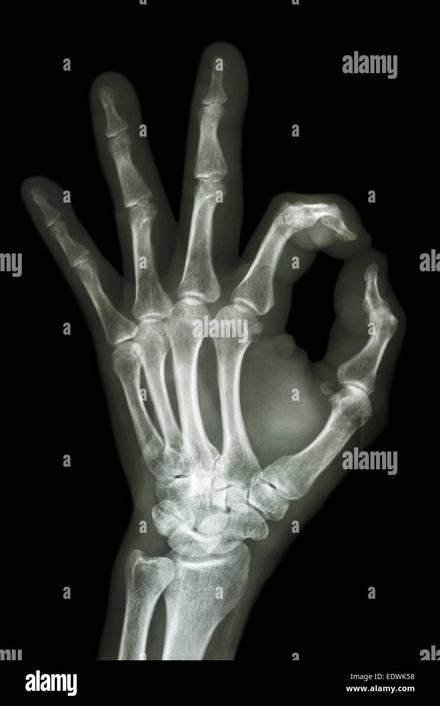 X-ray mano con simbolo OK Foto Stock