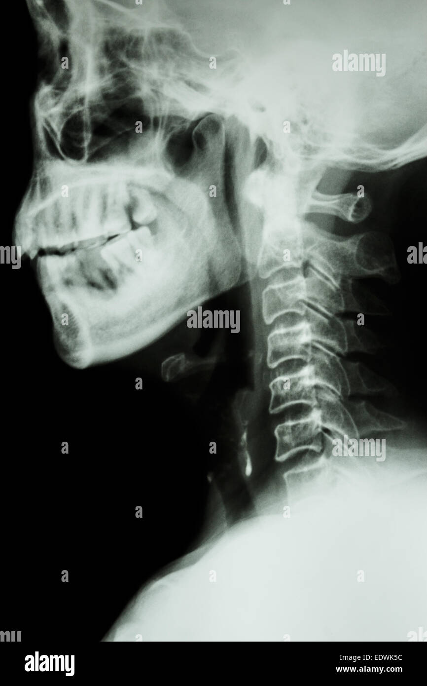 X-ray colonna cervicale dei popoli asiatici Foto Stock