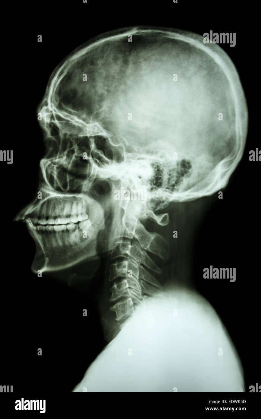 X-ray asian del cranio e della colonna vertebrale cervicale Foto Stock