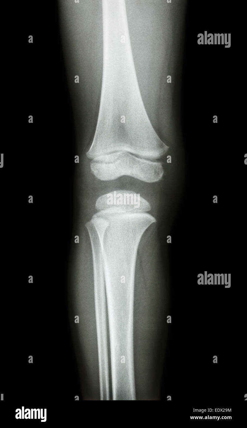Film x-ray ginocchio ap(antero-posteriore) del bambino Foto Stock