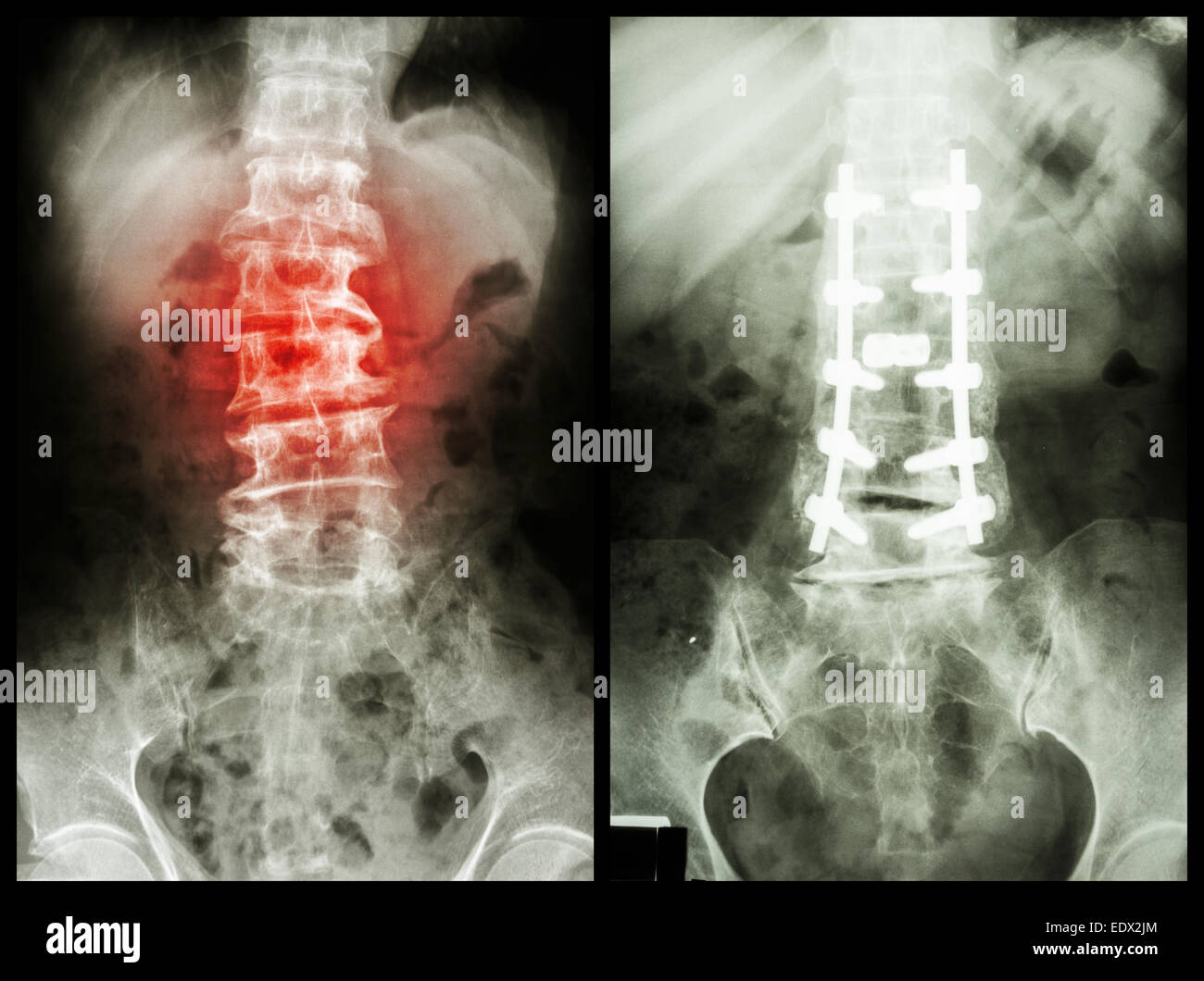 'Spondylosis' (immagine a sinistra) , Paziente è stata azionata e fisso interno. (Immagine a destra) Foto Stock