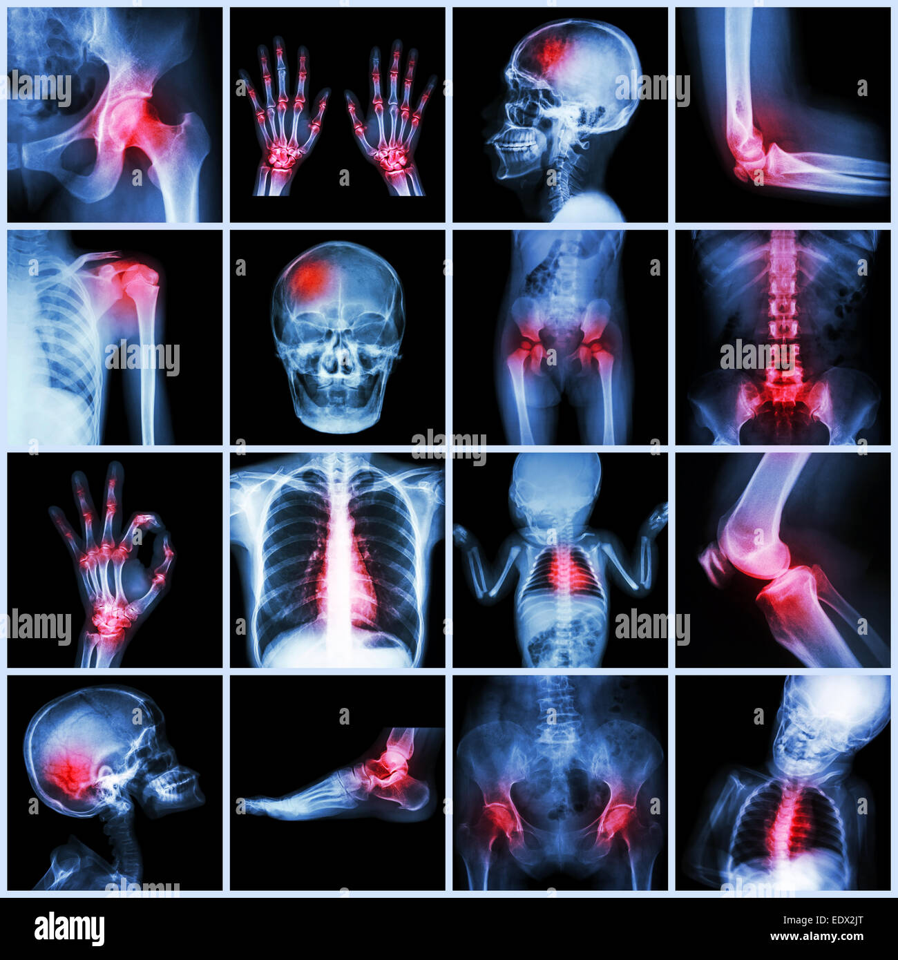 Collezione X-ray più parte dell'umana e Artrite,più malattia (Gotta , Artrite,malattia cardiaca congenita,corsa) Foto Stock