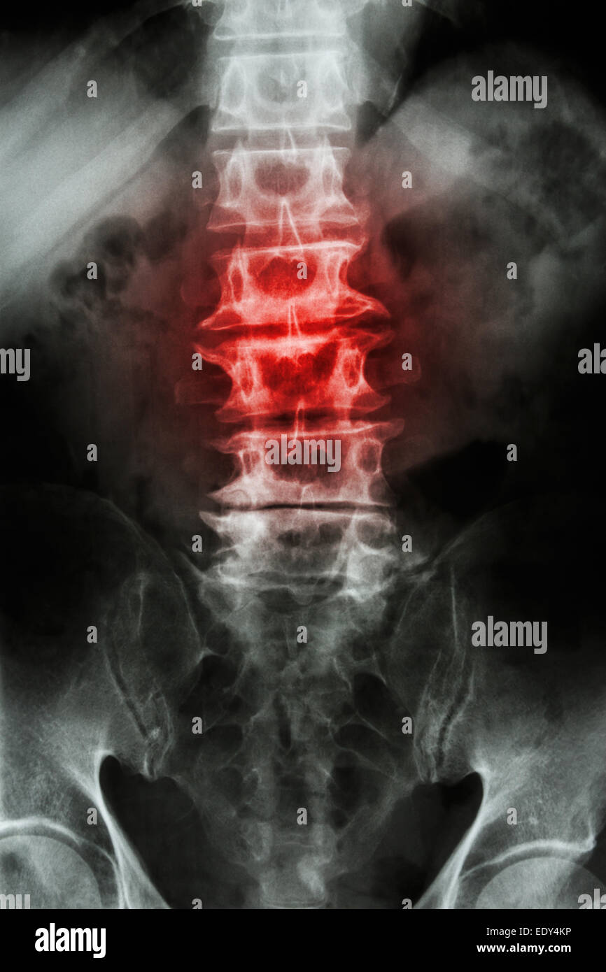 'Spondylosis' film x-ray L-S (dorso-lombare sacrum) di vecchia età paziente e infiammazione in corrispondenza della colonna vertebrale Foto Stock