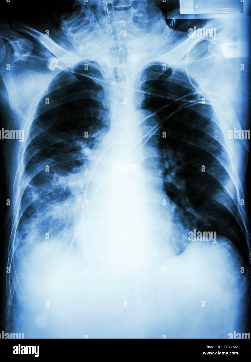 "Polmonite con insufficienza respiratoria film i raggi x al torace del paziente con tubo endotracheale,catetere. Egli è stato trattato nell'ICU. Foto Stock