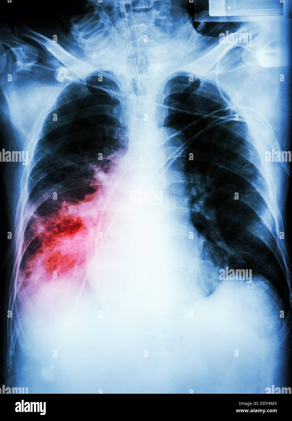 "Polmonite con insufficienza respiratoria film i raggi x al torace del paziente con tubo endotracheale,catetere. Egli è stato trattato nell'ICU. Foto Stock