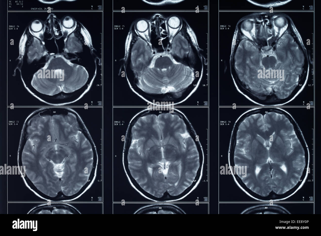 Testata a raggi X e la radiografia del cervello Foto Stock