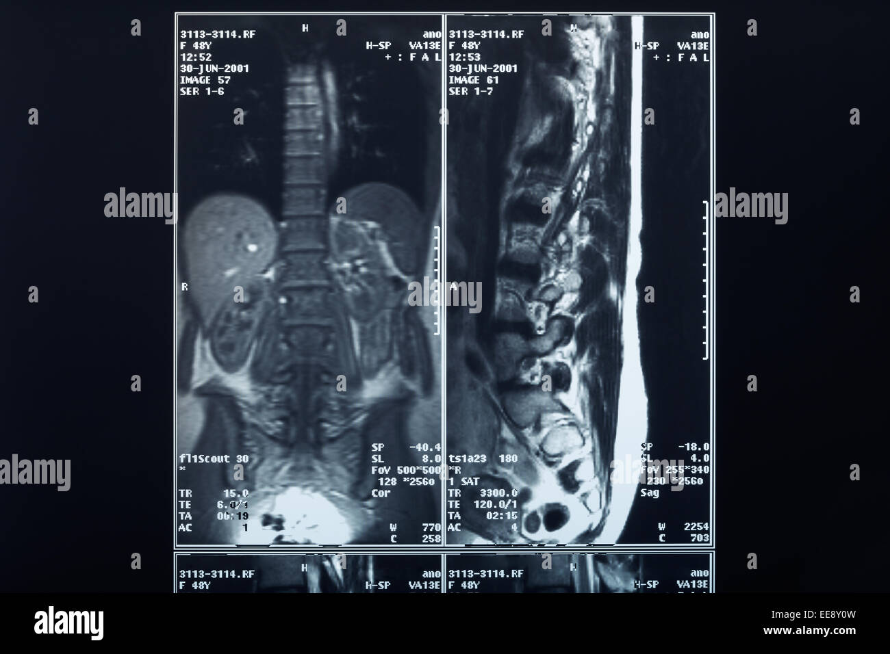 X-ray radiografia della colonna vertebrale Foto Stock