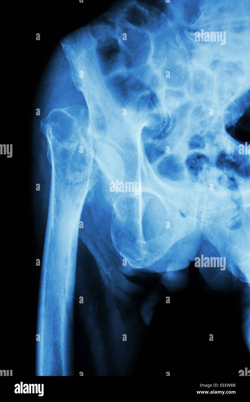 X-ray bacino & hip joint : testa di frattura del femore (thigh bone) Foto Stock