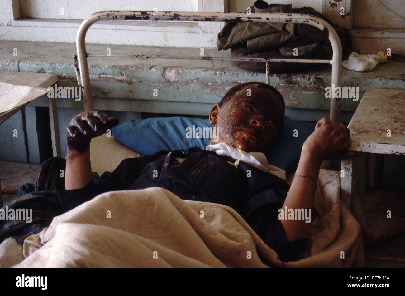 Ragazzo con gravi ustioni da esplosione di mine in ospedale a Kabul 1994 Foto Stock