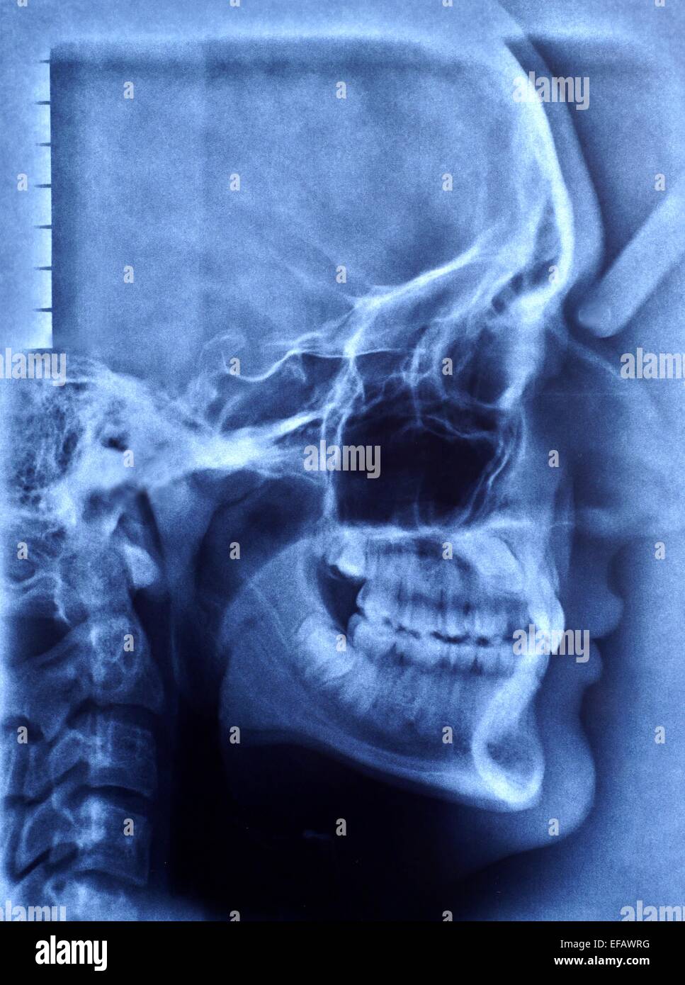 Immagine a raggi x del cranio umano Foto Stock