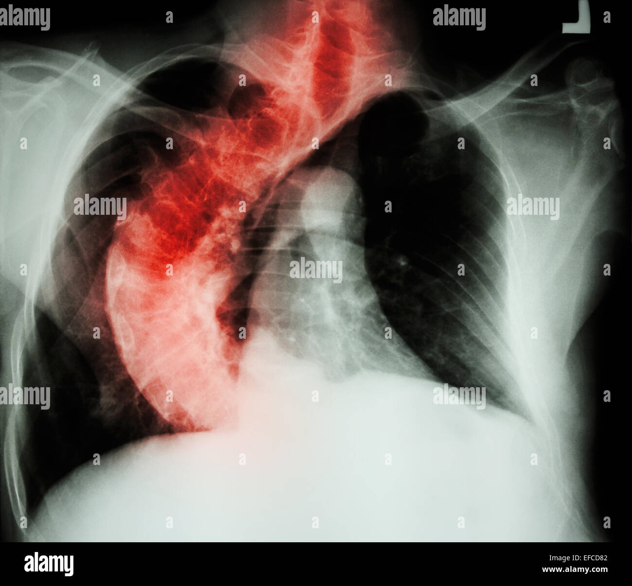 La scoliosi ( colonna vertebrale storta ) X-ray petto di persone anziane con la colonna vertebrale storta Foto Stock