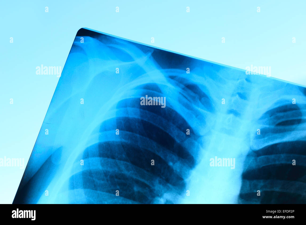 Immagine a raggi X del torace ossa di adulto, astratto sfondo blu Foto Stock