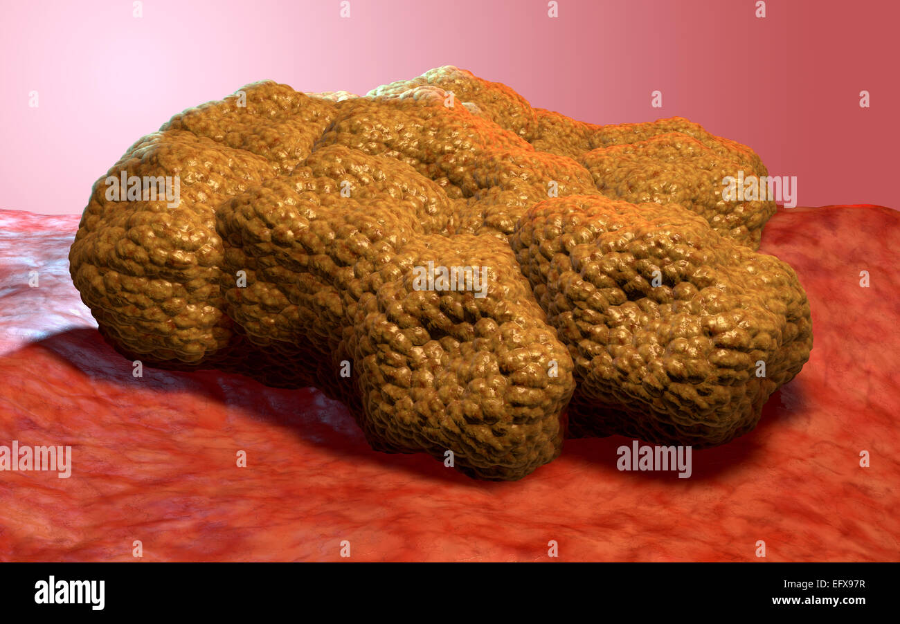 La cellula di cancro tumore, 3d Illustrazione medica Foto Stock