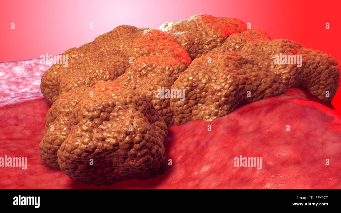 La cellula di cancro tumore, 3d Illustrazione medica Foto Stock
