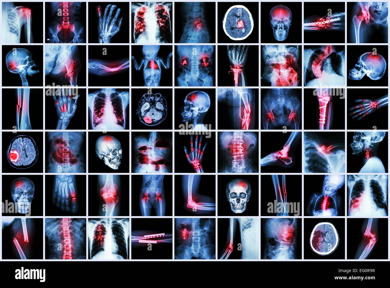 X-ray più Malattia del bambino e adulto ( corsa , artrite , frattura , la tubercolosi , tumore al cervello , occlusione intestinale , Ki Foto Stock
