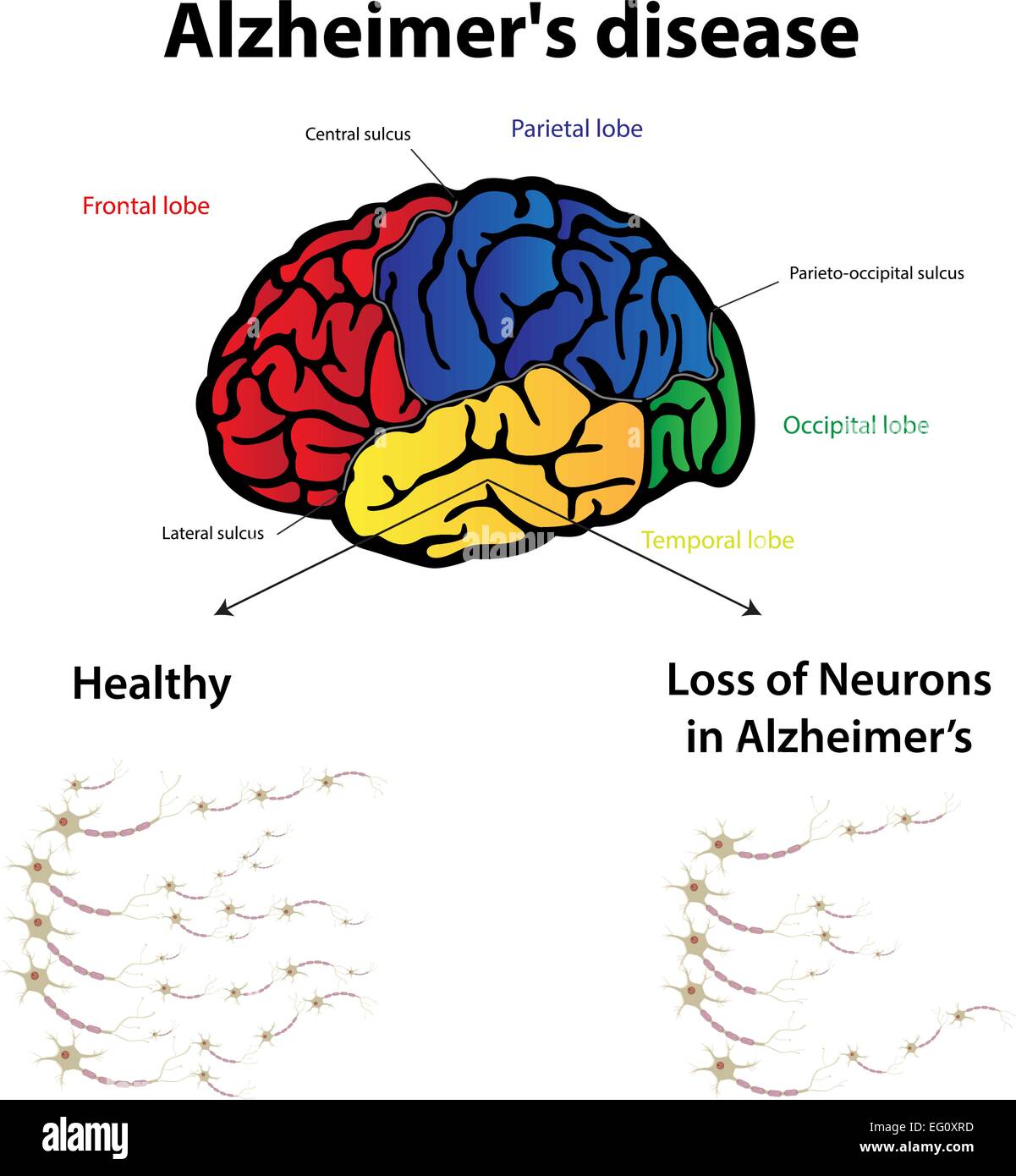 Il morbo di Alzheimer Illustrazione Vettoriale